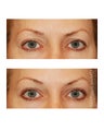 Eyelid Surgery