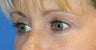 Upper Blepharoplasty and Lower Eyelid Skin Pinch
