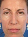 Eyelid Surgery