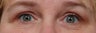 Eyelid Surgery