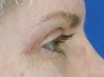 Eyelid Surgery