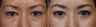 Before-After lower eyelid blepharoplasty