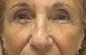 Browlift, ptosis repair, lower bleph and cheek lift