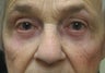 Upper  and Lower Blepharoplasty and Cheek Lift 