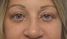 Upper  and Lower Blepharoplasty and Cheek Lift 