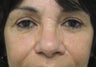 Browlift, upper and lower blepharoplasty, cheek lift 
