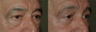 Eyelid Surgery