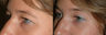 Eyelid Surgery