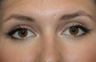Eyelid Surgery