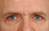 Eyelid Surgery