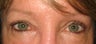 Eyelid Surgery