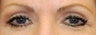 Eyelid Surgery