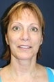 Blepharoplasty