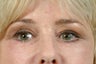 lower blepharoplasty