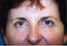 Blepharoplasty