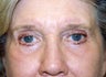 Blepharoplasty