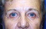 Blepharoplasty