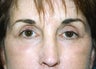 Blepharoplasty