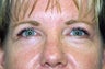Blepharoplasty