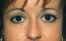 Blepharoplasty
