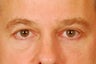 Upper and lower blepharoplasty, Browlift