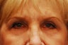 Upper Blepharoplasty