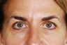 Upper Blepharoplasty