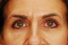 Upper Blepharoplasty