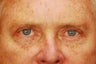 Upper and Lower Blepharoplasty