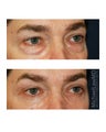 Facial Rejuvenation - Eyelid Surgery