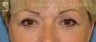 Eyelid Surgery