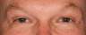 Eyelid Surgery