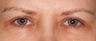 Eyelid Surgery