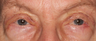 Eyelid Surgery