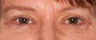 Eyelid Surgery