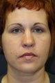 Blepharoplasty Upper and Lower