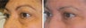 Lower Blepharoplasty