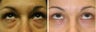 Lower Blepharoplasty - Transconjunctival