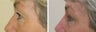 Upper blepharoplasty