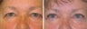 Upper blepharoplasty