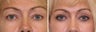 Upper blepharoplasty