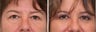 Upper blepharoplasty