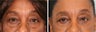 Lower blepharoplasty