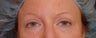 Eyelid Surgery