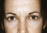 Eyelid Surgery