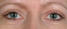 Eyelid Surgery