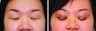 Double Eyelid Surgery Suture