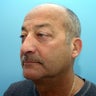 Eyelid Surgery