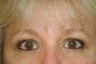 Eyelid Surgery