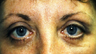 Eyelid Surgery